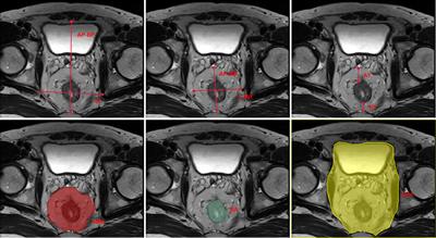 Prognostic value of mesorectal package area in patients with locally advanced rectal cancer following neoadjuvant chemoradiotherapy: A retrospective cohort study